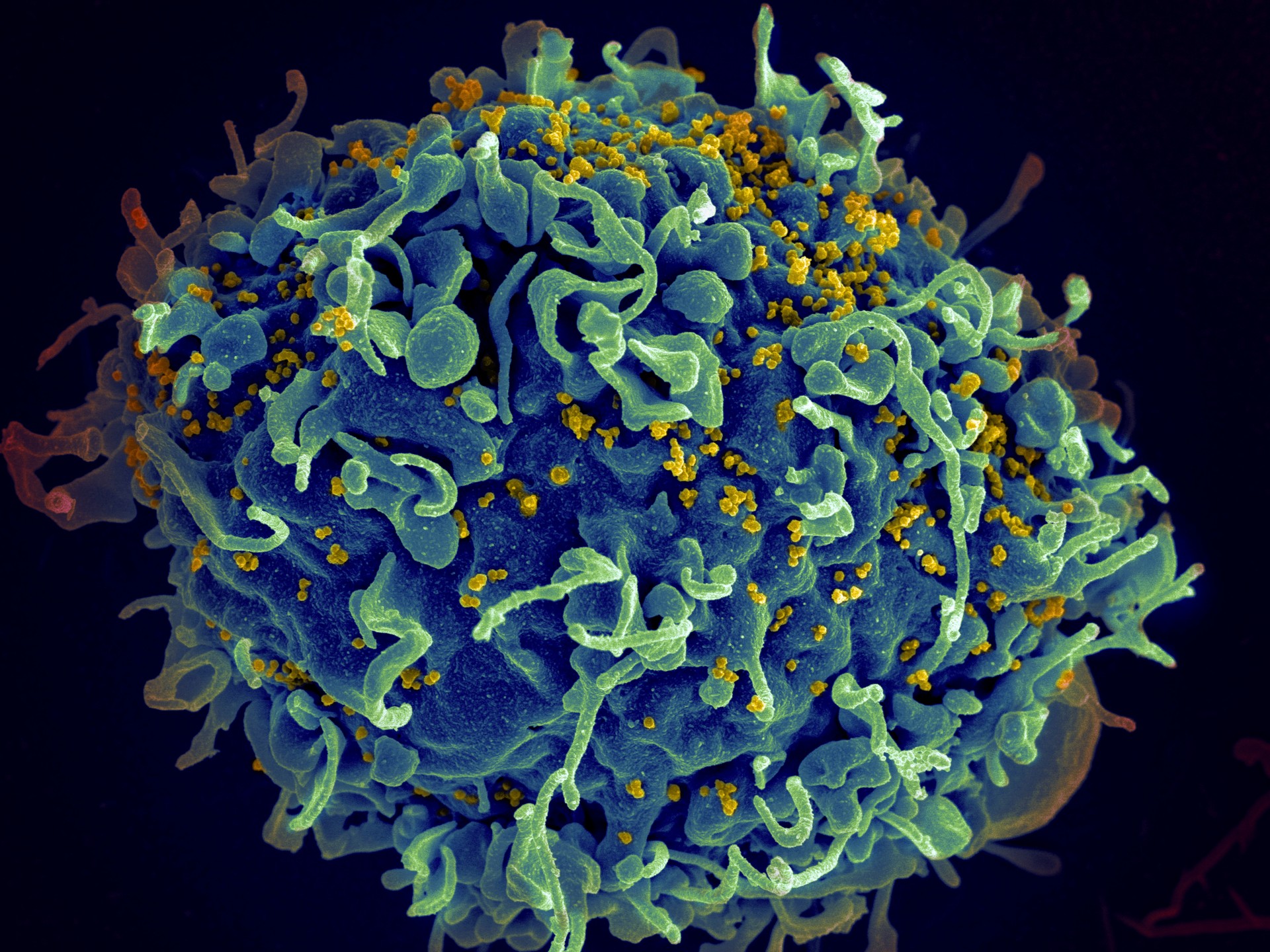 Sistema inmune de 'Paciente esperanza' elimina el VIH sin medicamentos