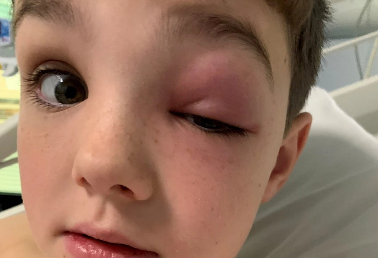 Inglaterra: Niño desarrolla raro síntoma de covid en el ojo