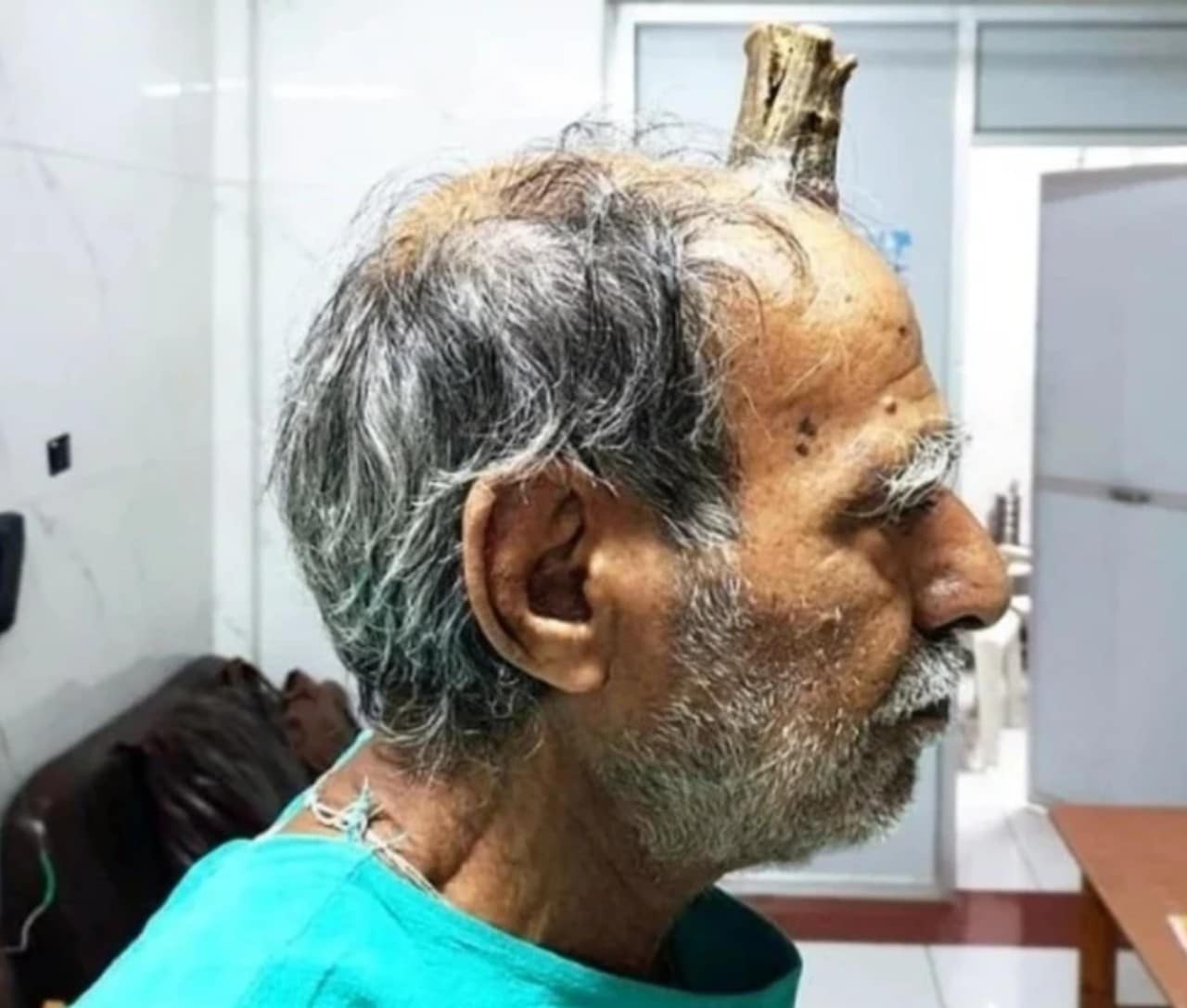 India: remueven cuerno del diablo a un hombre
