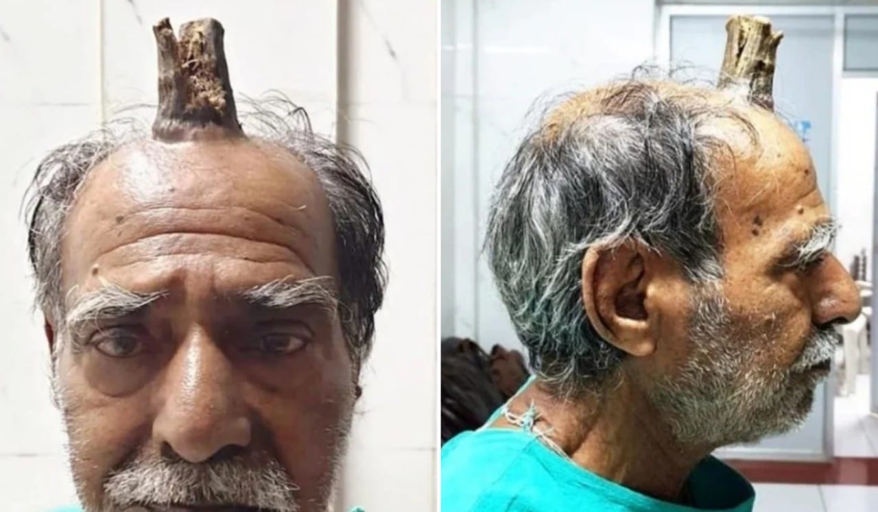 India: remueven cuerno del diablo a un hombre