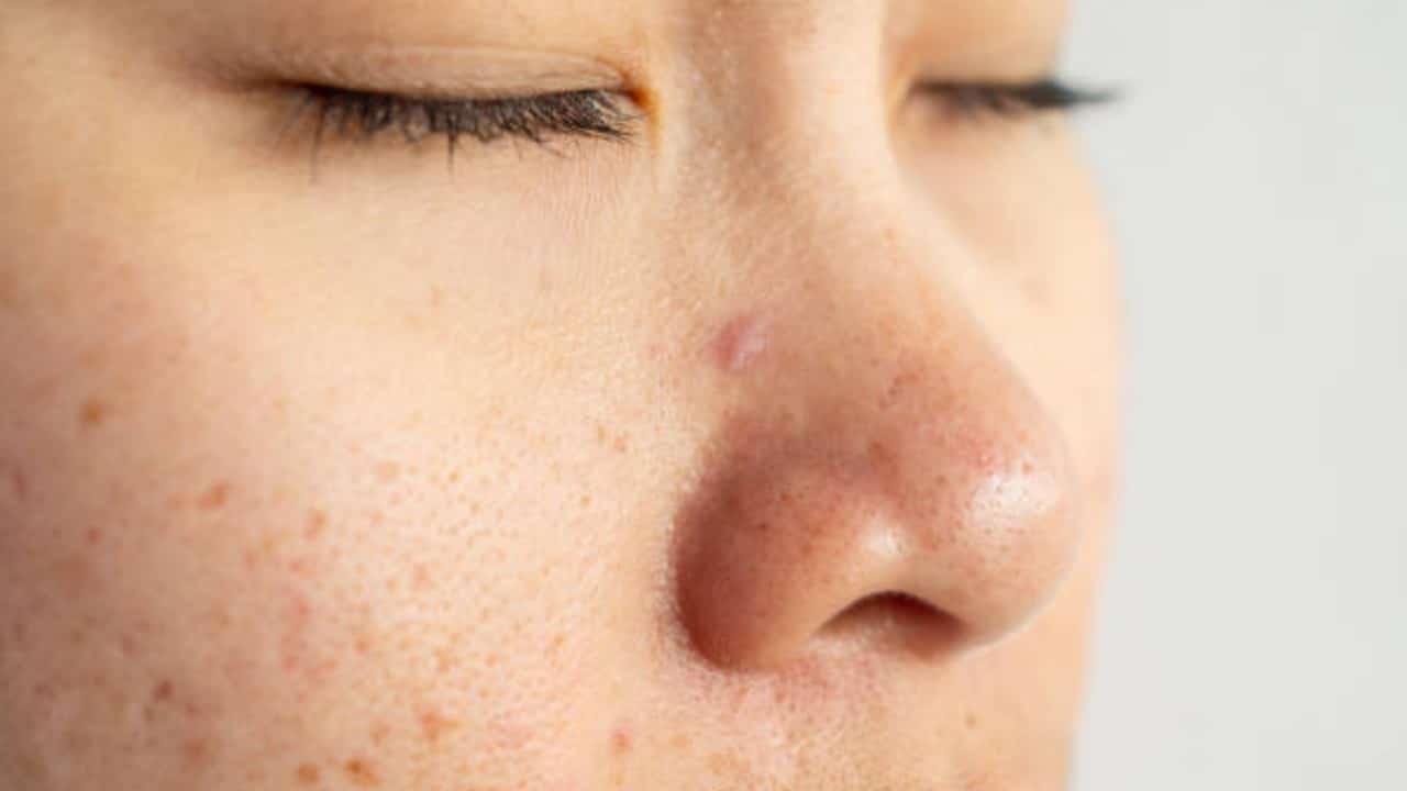 acne getty
