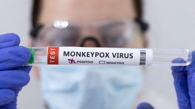 Imagen que muestra una prueba positiva de viruela del mono, Fuente: Reuters